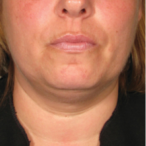 ultherapy_before-90days