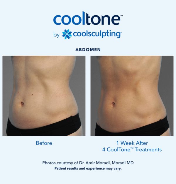 CoolTone by CoolSculpting in Redmond, Oregon